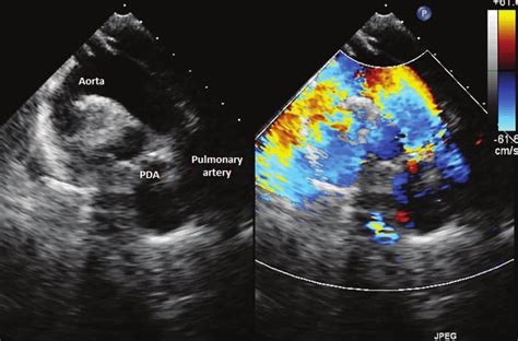 Echocardiogram/Doppler Transthoracic .